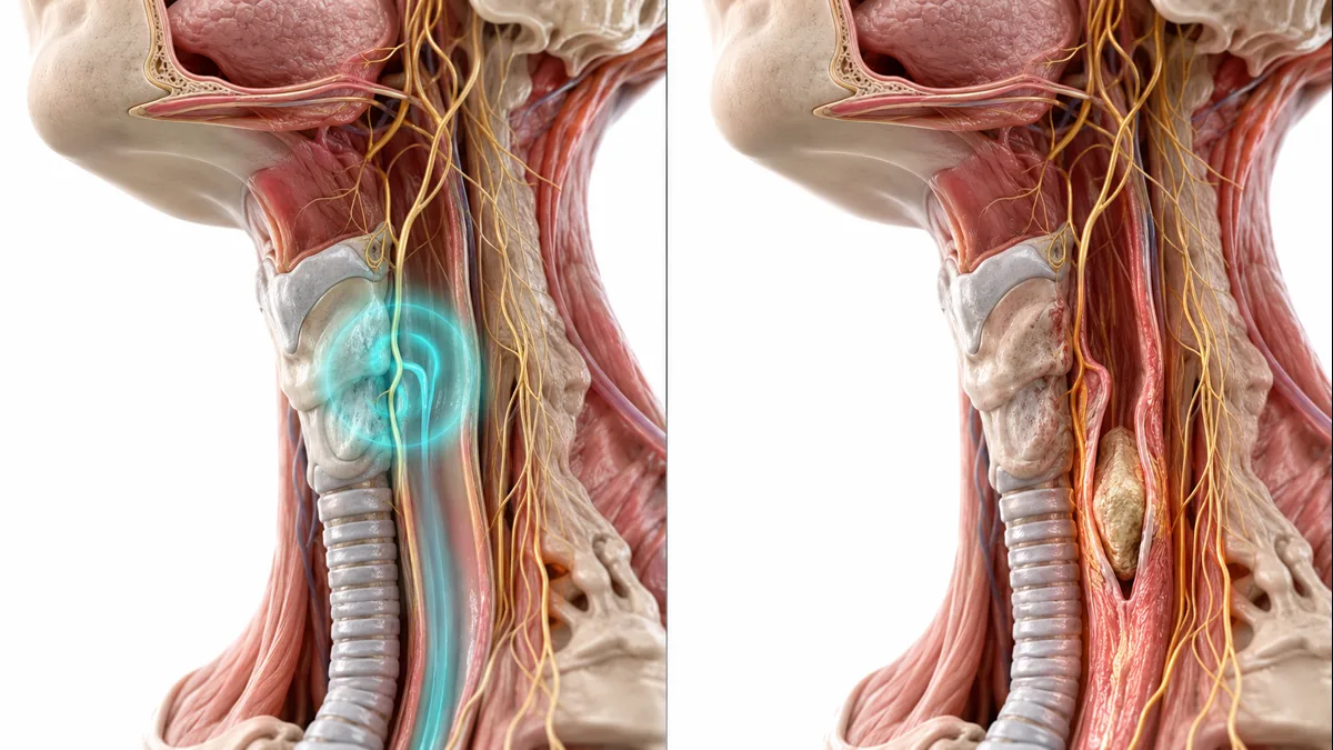 Comparison illustration showing globus sensation as a phantom lump versus dysphagia with actual food obstruction in the esophagus